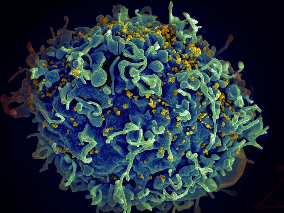Aids (HIV) Tükürükle Bulaşır Mı?