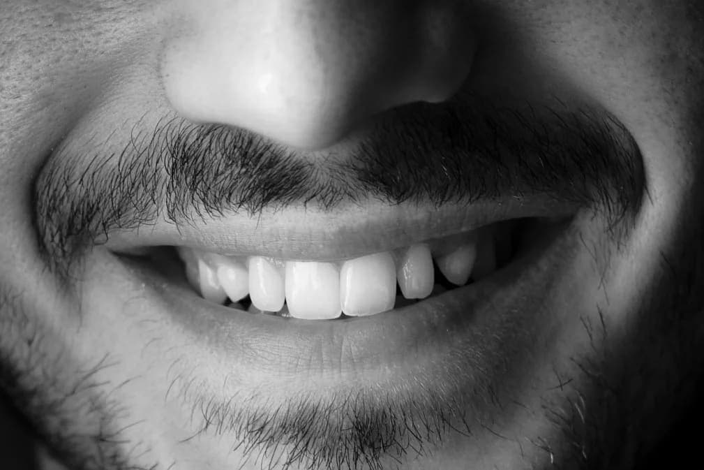 Diş Beyazlatma Zararlı Mı? Zararları Nelerdir?