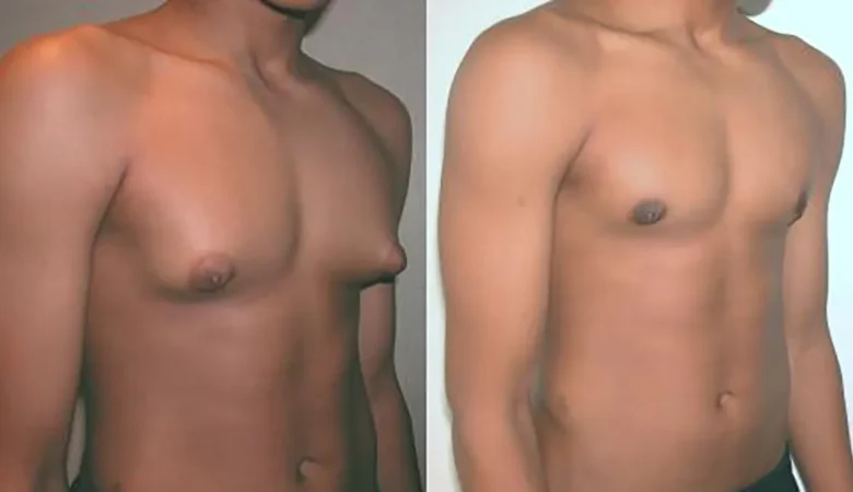 Jinekomasti Nedir, Nasıl Fark Edilir ve Tedavi Yöntemleri