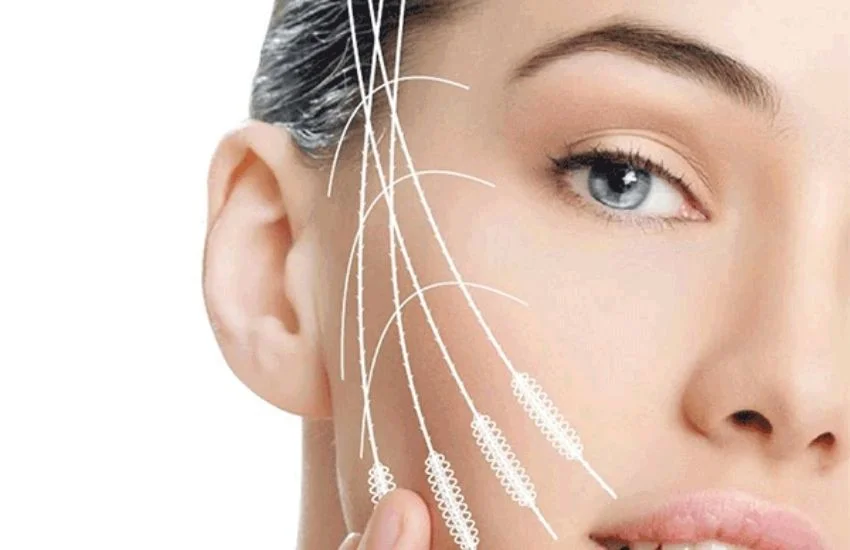 Kolajen İp Nedir? Nasıl Uygulanır? Faydaları ve Zararları 1 Kolajen İp Nedir? Nasıl Uygulanır? Faydaları ve Zararları