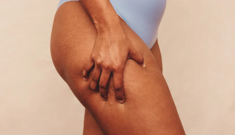 Portakal Kabuğu Görünümünden Nasıl Kurtulurum?