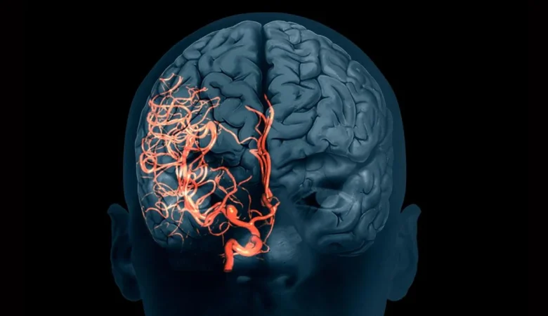 Anevrizma Nedir? Neden Olur? Öldürür Mü?