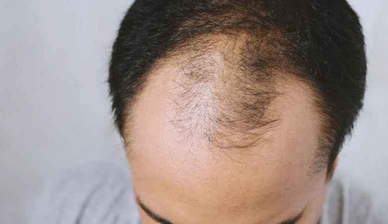 Steroid Kullanmak Saç Dökülmesine Neden Olur Mu?