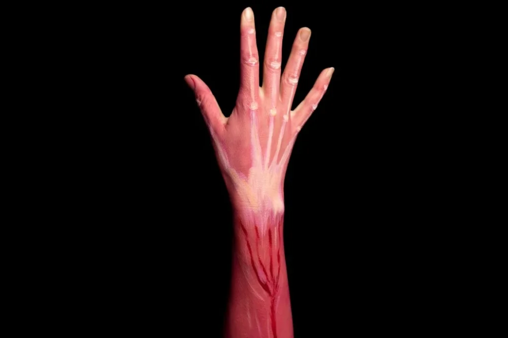 Kas Yırtılması Neden Olur Nasıl Tedavi Edilir