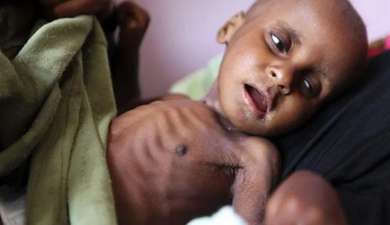 Marasmus Nedir? Belirtileri ve Tedavisi