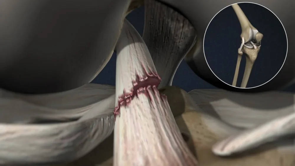 Ön Çapraz Bağ Sakatlanması Nedir